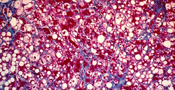 NASH-Fibrose