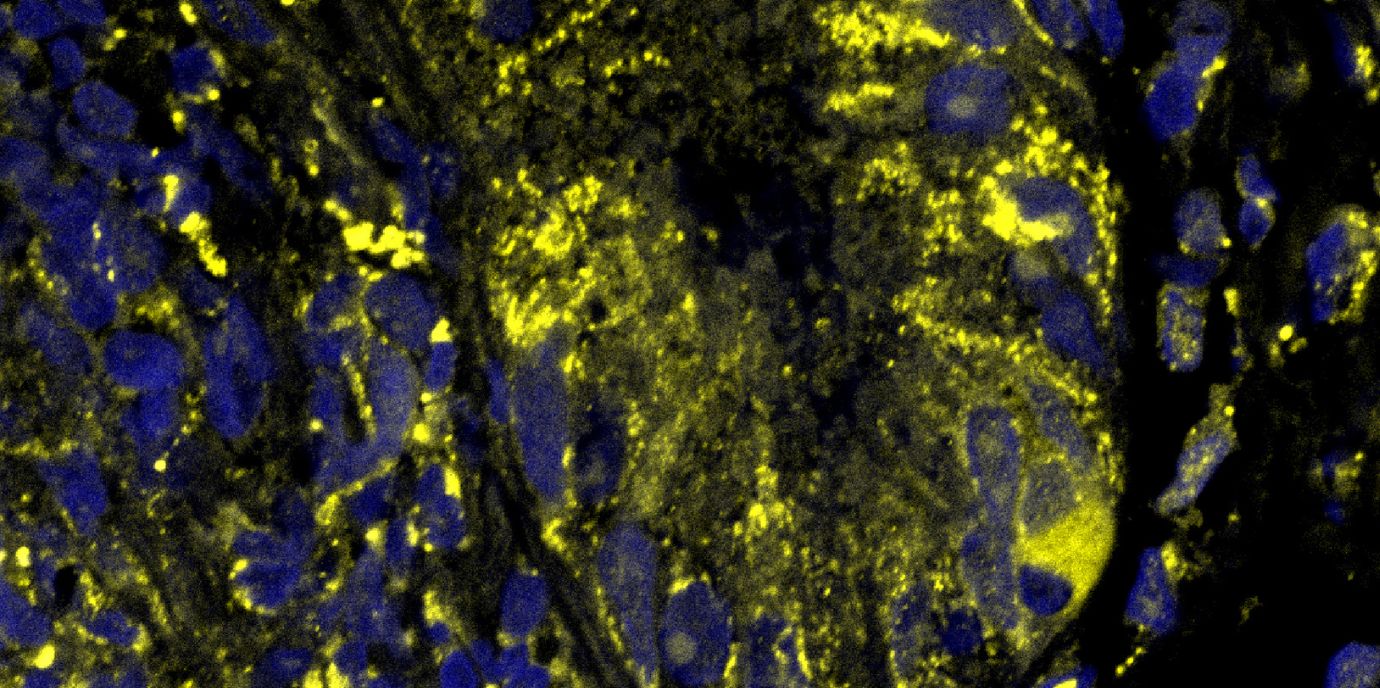 Dünndarmepithel aus der Kryptenregion eines Morbus Crohn Patienten. In Gelb: RXRalpha Expression. Blau: Zellkerne. Copyright: Gastroenterologisches Labor/Moritz Meyer. NEWS_CellMetabolism.jpg