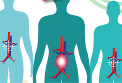 Gefäßtag 2015: Zeitbombe im Bauch