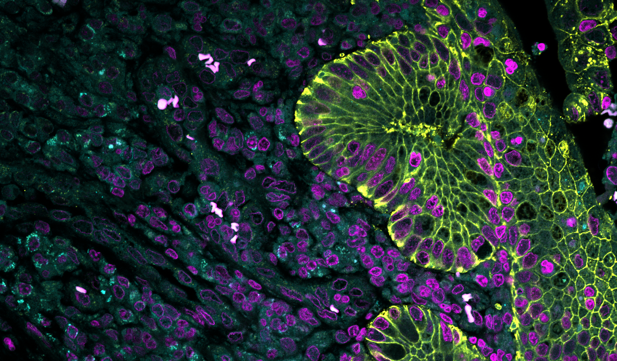 Neuer prognostischer Biomarker für Morbus Crohn