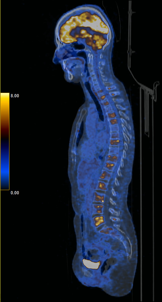 Die Abbildung zeigt eine Patientin mit Brustkrebs und Knochenmetastasen in der Wirbelsäule. (c)Nuklearmedizin Innsbruck/Virgolini/Rossetti