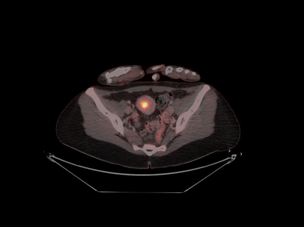 Abbildung eines Endometriumkarzinoms (gelb leuchtend) aus der PET-CT-Bildgebung.(c)Univ.-Klinik für Nuklearmedizin Innsbruck/Rossetti